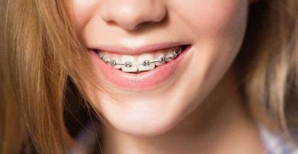 Different Types Of Orthodontic Brackets Dr Jamilian