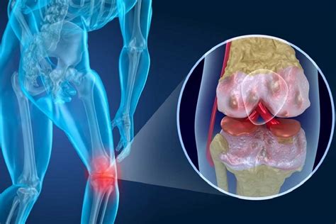 Artritis Reumatoide Explicacion Significado E Importancia De Conceptos