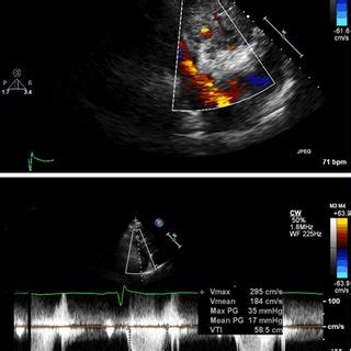 Two Dimensional Echocardiogram Showed An Estimated Left Ventricular