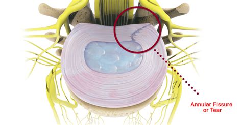 Annular Fissure Definition Spine Info