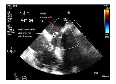 Two Dimensional Transesophageal Echocardiography Midesophageal