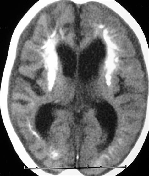 Intracranial Lesions With High Signal Intensity On T Weighted Mr