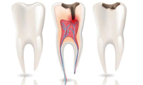 Understanding The Symptoms Of A Root Canal Infection