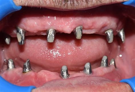 Odontología Especializada: Recupera todos tus Dientes con Implantes ...