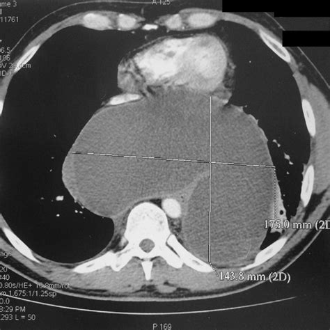 Thoracoabdominal Computed Tomography Showing A Large Cystic Mass