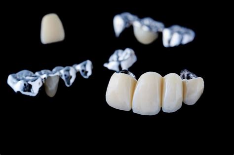 Fixed Bridge Dreamland Dental And Orthodontics