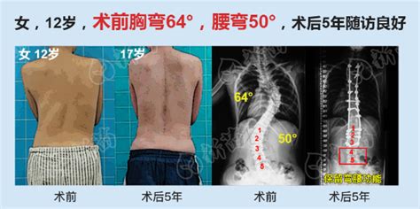 特发性脊柱侧弯手术，最大保留功能案例广东省新苗脊柱侧弯预防中心 脊柱侧弯新苗基金