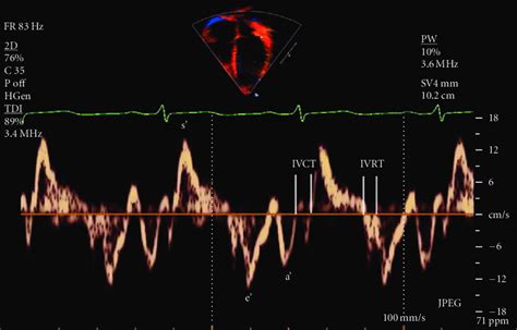 Lateral Mitral Annular Tissue Doppler Tracing S Peak Velocity During