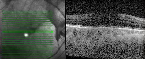 Right eye--Increased central retinal thickness on OCT of macula with ...