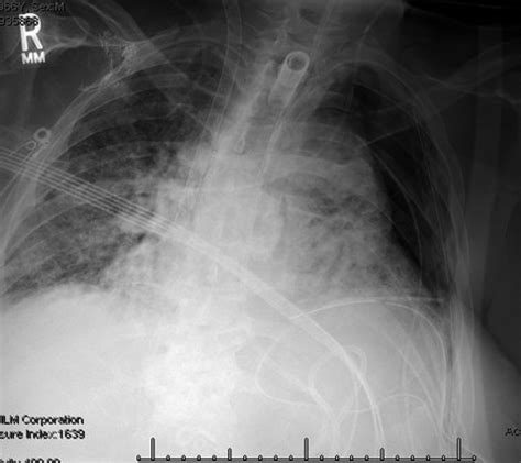 A Successful Daptomycin And Micafungin Dosing Strategy In Venovenous