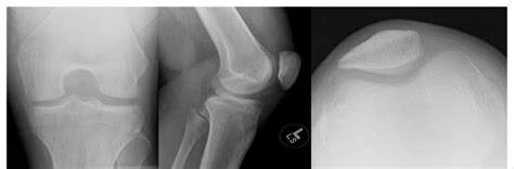 Sunrise, AP and Lateral views of the left knee show no abnormality ...