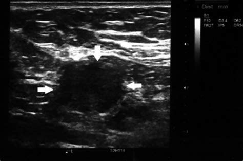 Cervical Lymphadenopathy Ultrasound