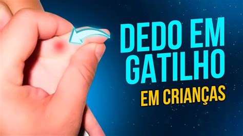 DEDO EM GATILHO EM CRIANÇA SINTOMAS CAUSA E TRATAMENTO FIX IT YouTube