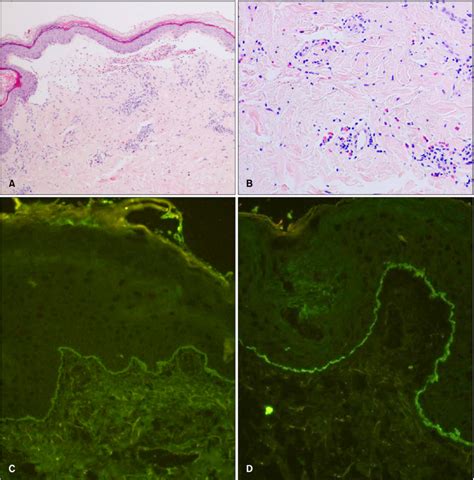 A Subepidermal Blister With Superficial Inflammatory Infiltrate B Download Scientific