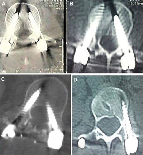 Various Screw Positions A Perfect Position Of Screws Bilaterally Download Scientific