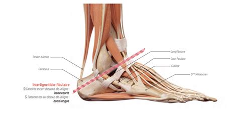 AVANTAGES DES BOTTES DIMMOBILISATION COMMENT SOIGNER UNE ENTORSE