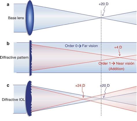 Near Vision After Cataract Surgery With Multifocal Intraocular Lens