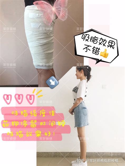 什么是水动力吸脂？效果如何？ 知乎