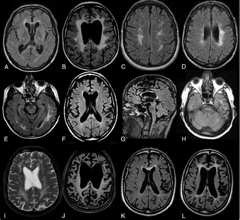 Figure 1 From Adult Onset Leukoencephalopathy With Axonal Spheroids And