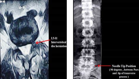 A Mri Scan Showing L5 S1 Intervertebral Disc Herniation B X Ray Download Scientific