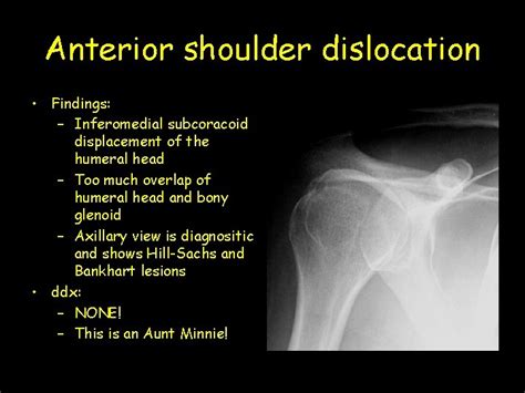 Anterior Shoulder Dislocation Findings Inferomedial Subcoracoid Displacement Of