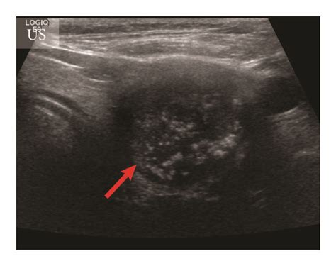 Imaging Of The Primary Tumor In Medullary Thyroid Carcinoma A C