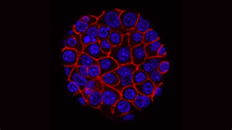 Câncer de pâncreas muda a forma como se alimenta para proliferar no