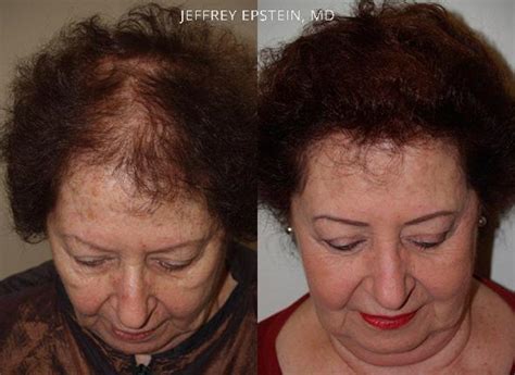 Hair Transplants For Women Photos Miami Fl Patient41406