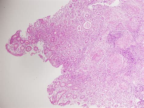 Figure Histopathology Of Gastric Mucosal Biopsy Showed Discreet