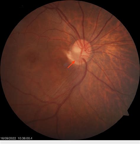 Figure 1 From A Classical Presentation Of Optic Disc Pits With Complex