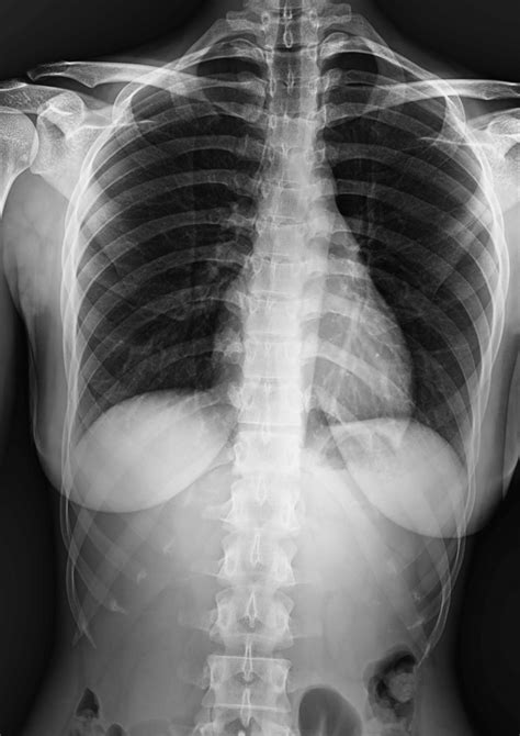 Mobile Chest X Ray Solution Atx Medical Solutions