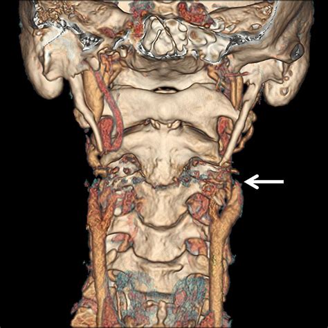 Eagle Syndrome Revisited Cerebrovascular Complications Annals Of