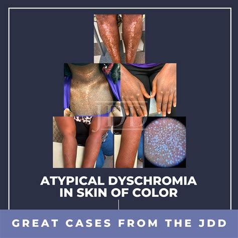 Atypical Dyschromia in Skin of Color - Next Steps in Dermatology