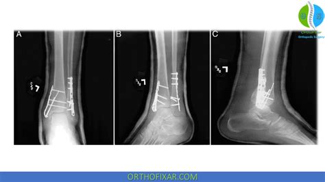 Treatment Of Medial Malleolus Fracture Orthofixar 2025