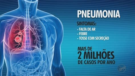 Pneumonia Como Pegar E Quais Os Sintomas Prof Nildo Mello YouTube