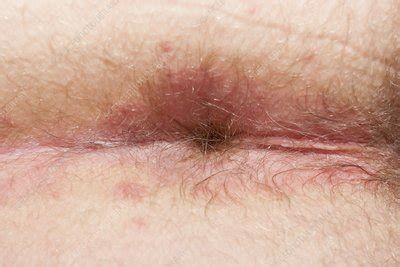 Perianal Dermatitis Stock Image C019 4108 Science Photo Library