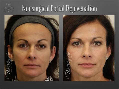 Non Surgical Facelift New Orleans Center For Aesthetics And Plastic Surgery