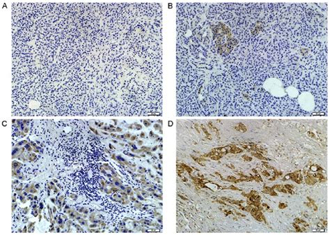 Immunohistochemical Analyses Of The Expression Of Cd133 In