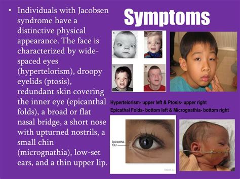 Jacobsen Syndrome Ppt Jacobsen Syndrome Powerpoint Presentation Free