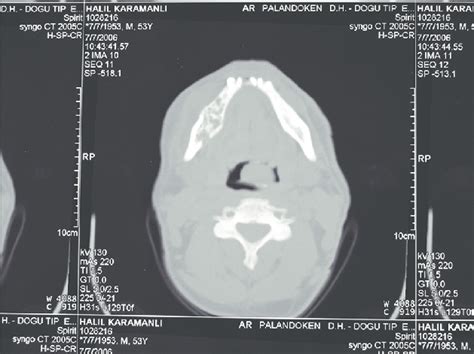 Ct Scans Of The Maxillofacial Region Download Scientific Diagram