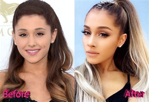 Ariana Grande Before and After Cosmetic Surgery