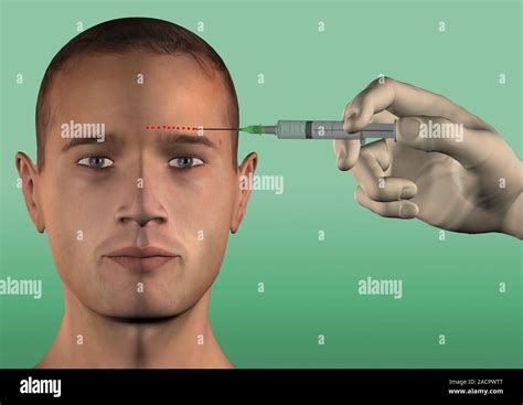 Supraorbital nerve block. Artwork of a syringe being used to inject a ...