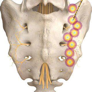 PDF Cooled Radiofrequency Ablation Of The Sacroiliac Joint A