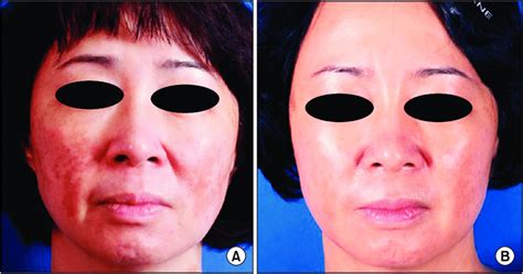 A Case Of Typical Malar Facial Melasma With Vascular Components That