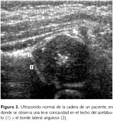 Ultrasonido ortopédico de la cadera infantil