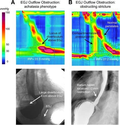 Presentation Diagnosis And Management Of Achalasia Clinical