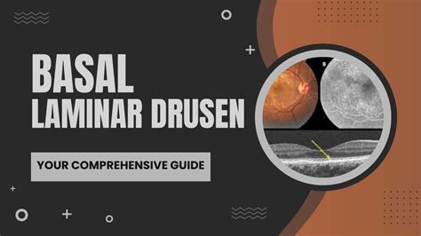 Unlocking The Secrets Of Basal Laminar Drusen: Your Comprehensive Guide ...