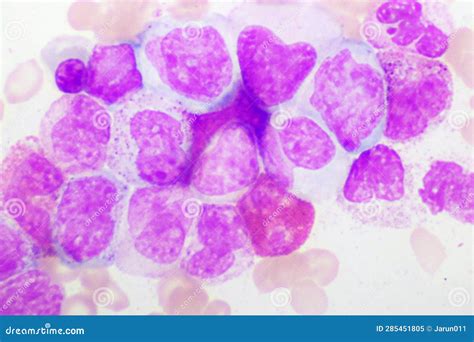 Chronic Myeloid Leukemia Cells Or Cml Stock Image Image Of Care