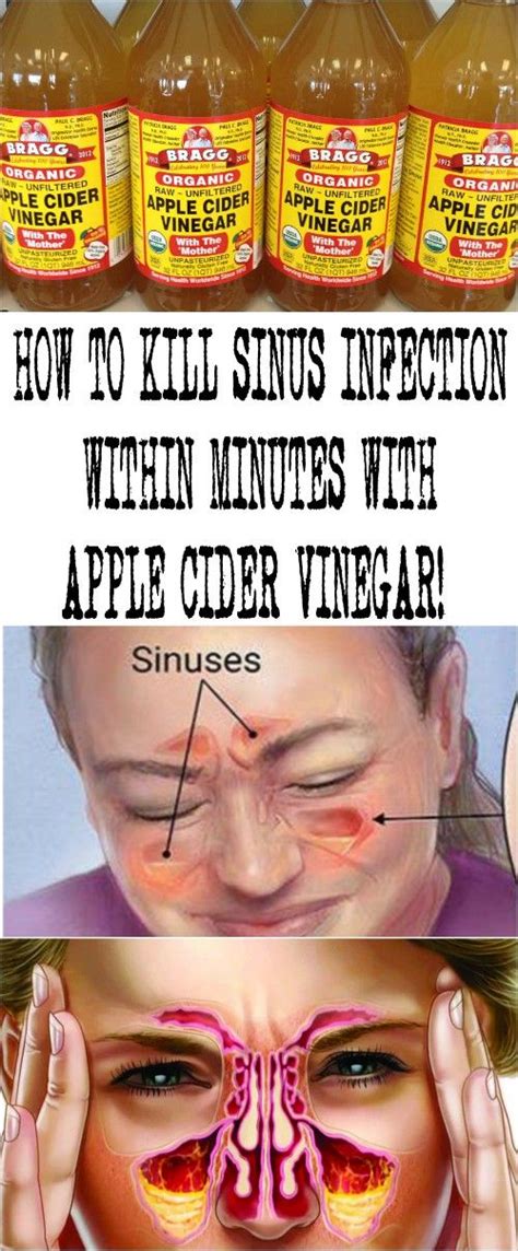 How To Treat Sinus Infection Within Minutes With Apple Cider Vinegar Apple Cider Vinegar