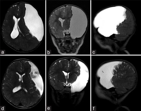 Intracranial Arachnoid Cysts Pediatric Neurosurgery Update Surgical